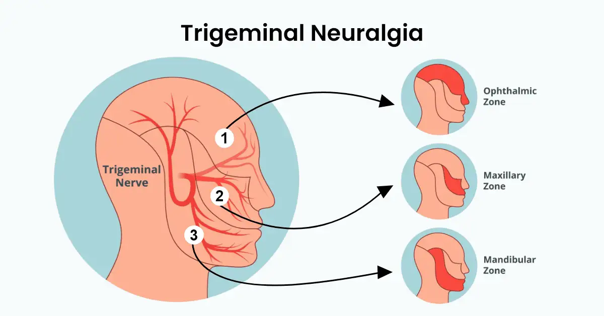 Trigeminal-Neuralgia