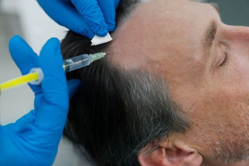 PRP Hair Treatment